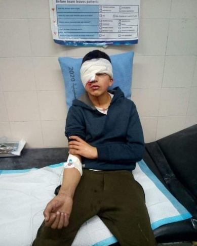 جيش الاحتلال يصيب طفل من الخليل في عينه ويفقد البصر بها